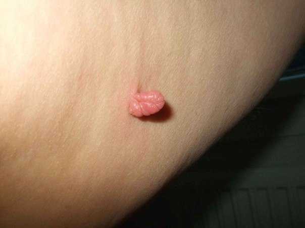 papilloma3.jpg